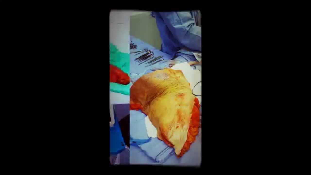 Abdominoplasty by Dr. Micheloudakis